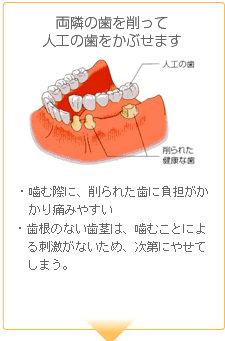 噛む際に、削られた歯に負担がかかり痛みやすい歯根のない歯茎は、噛むことによ
　る刺激がないため、次第にやせて
  しまう。