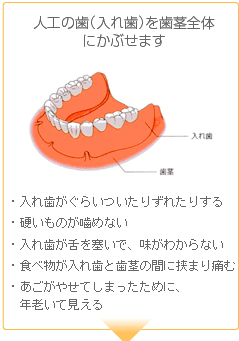 人工の歯(入れ歯)を歯茎全体