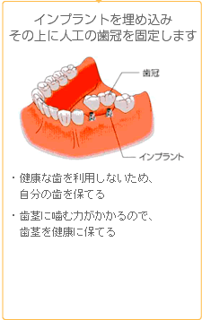 インプラントを埋め込みその上に人工の歯冠を固定します