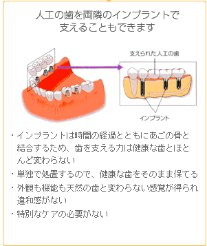 人工の歯を両隣のインプラントで支えることもできます